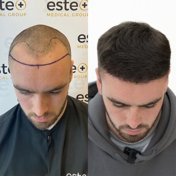 Callum Este Glasgow Hair Transplant Client 7Weeks & 7Months After